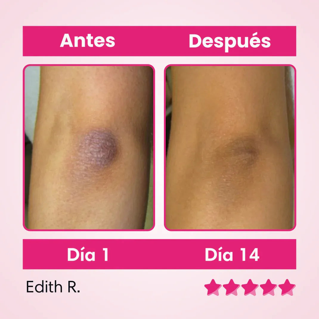 Crema Aclarante De Zonas Oscuras: Puedes usarlo en axilas, cuello, zona íntima, codos y rodillas. ¡Lleva Gratis un Tratamiento Capilar!