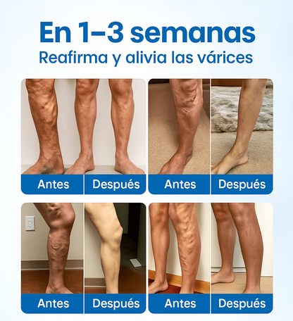 Varicose Veins™ Spray Anti Várices – Piernas más sanas, ligeras y sin dolor